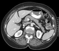 Abdomen / Pelvis CT Scan: St. Elizabeth's Medical Center | Steward ...